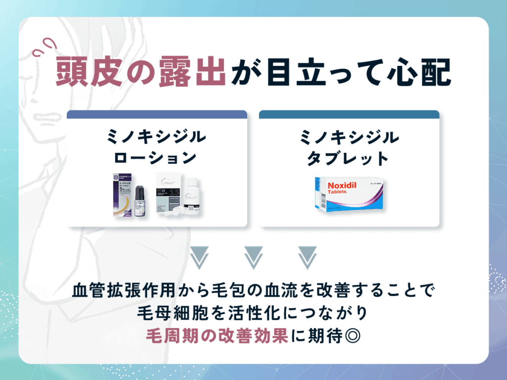 頭皮の露出が目立つ対策のはげ薬ならミノキシジルがおすすめ